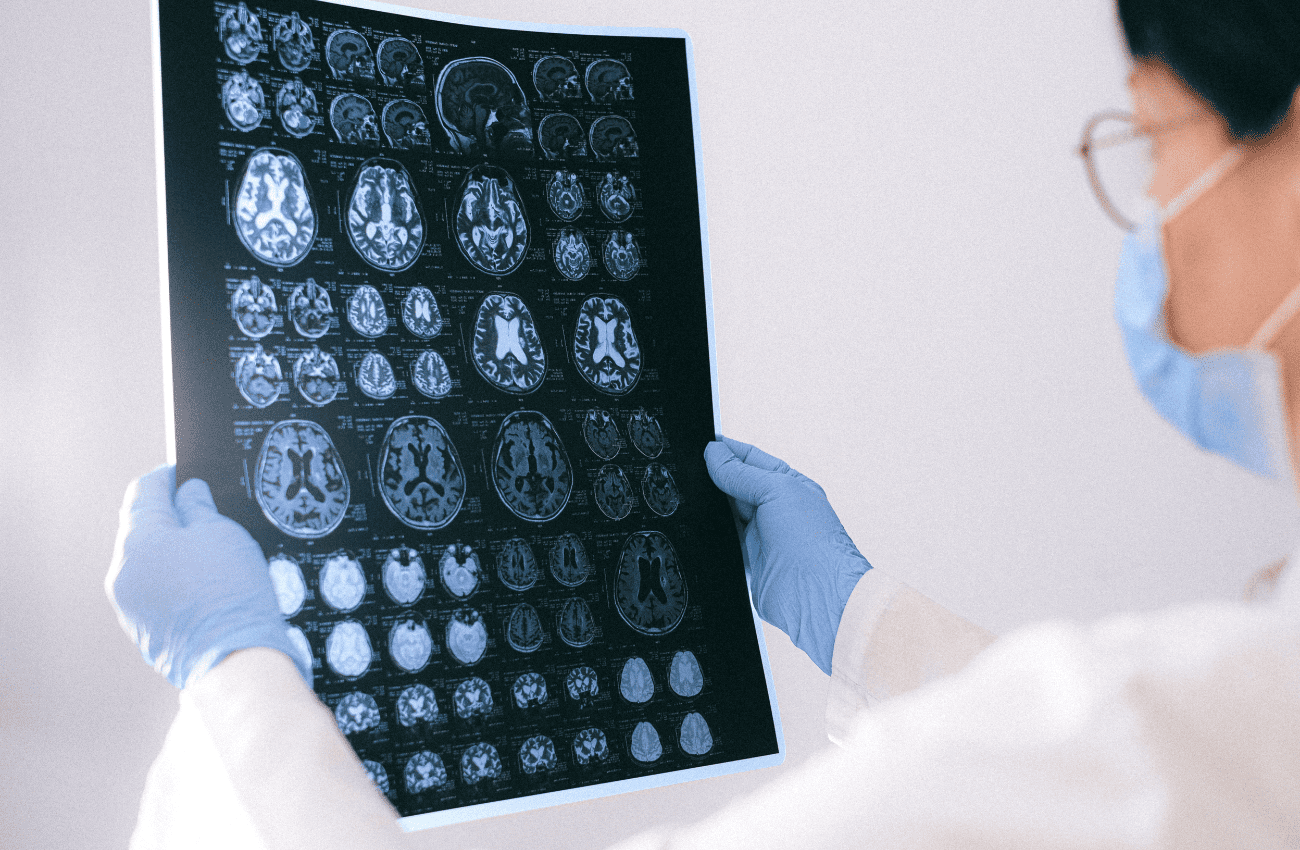 negligencia médica por ictus